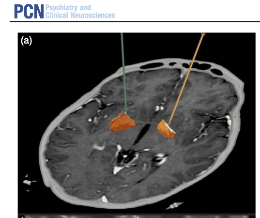 PCN_Psychiatry's tweet photo. One-year outcomes of deep brain stimulation in refractory Tourette syndrome
https://t.co/2pc1G40XAm
#deep_brain_stimulation #DBS #refractory #TouretteSyndrome https://t.co/tanYZtJaPc