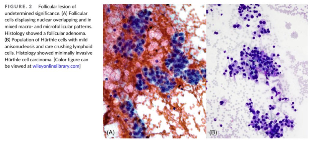 PapSociety's tweet photo. 💫New released and worth reading article @DiagnosticCyto 💫 "Two-tier subclassification of the Bethesda  III (AUS) in thyroid cytology”
https://t.co/f1vaR8qLMp @IACytology @BAC by @JudyShi8 posted by social media committee @PSC @PoonamVohra3 @Michaelclaire1 @ekhanafshar@ https://t.co/qH0vV7WqXF