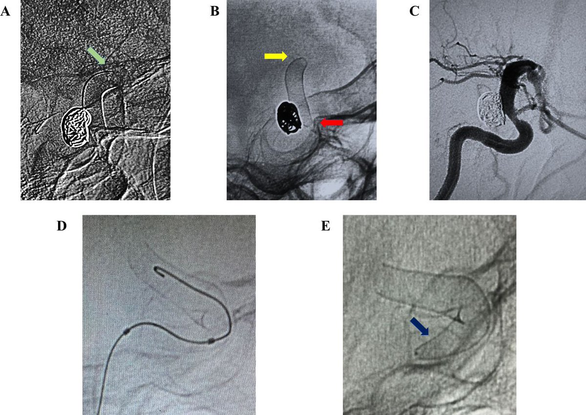 Study of 3572 patients reveals low rates of low rates of fish-mouthing, device braid narrowing, collapsing, and deformation with flow diversion for intracranial aneurysms. More studies needed to establish standardized definitions for FD braid changes bit.ly/3RUm8Nk