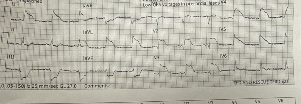 Last Friday, our consult team <a href="/UToledoMed/">UToledo Medicine</a> @UTMedCenter made an excellent call on a 66-year-old male who presented as STEMI alert with sudden onset chest pain referred to neck and back with sudden bilateral lower extremity weakness that progressed to paralysis. 
#CardioTwitter