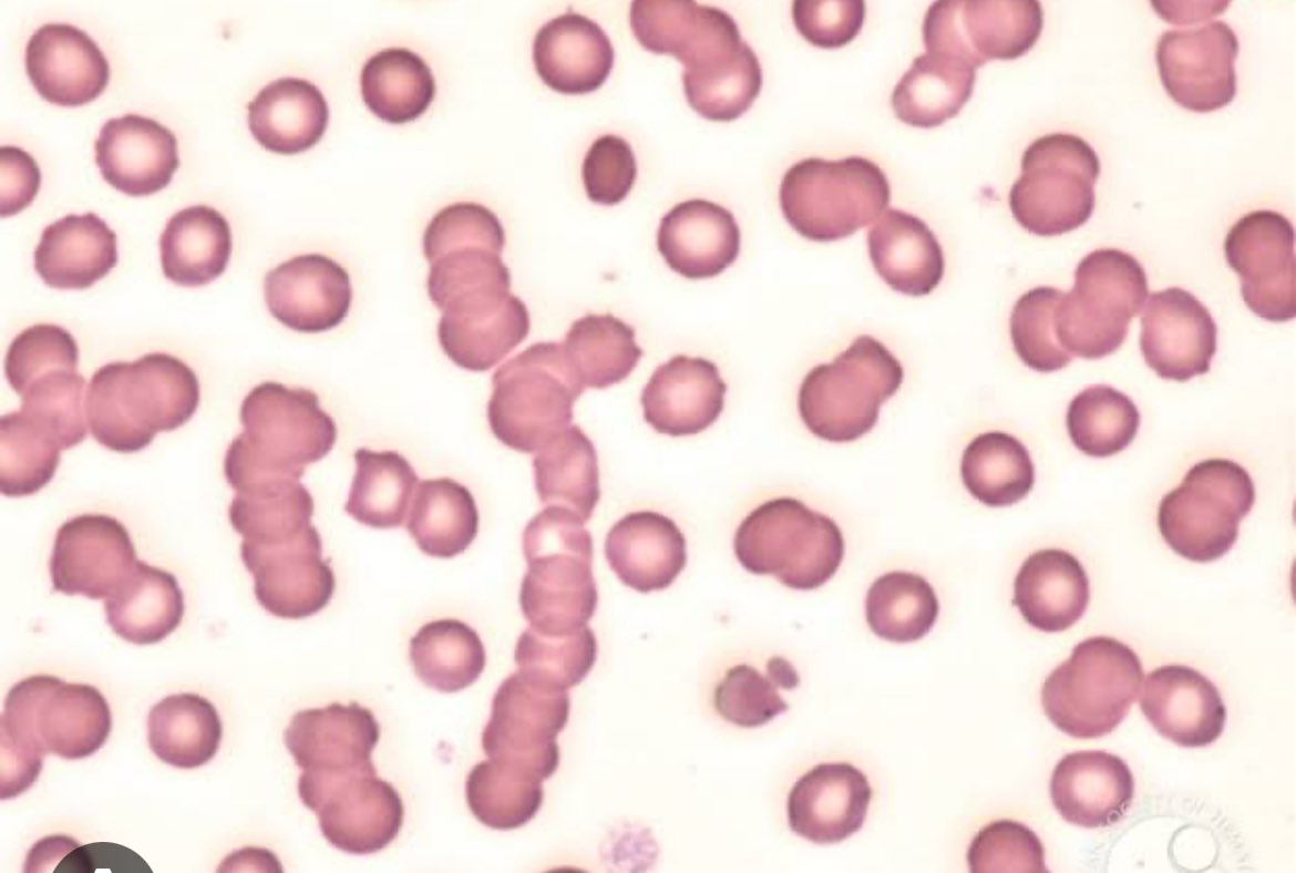 🩸🔥Why peripheral blood film is important for a nephrologist 🫘🤔

👀Look for 

✅Burr cells/echinocytes-CKD

✅Schistocytes-Microangiopathic hemolytic anemia 

✅Rouleaux-🥞look for multiple myeloma 

✅Basophilic stippling-lead poisoning 

✅Pencil ✏️cells/elliptocytes-Iron