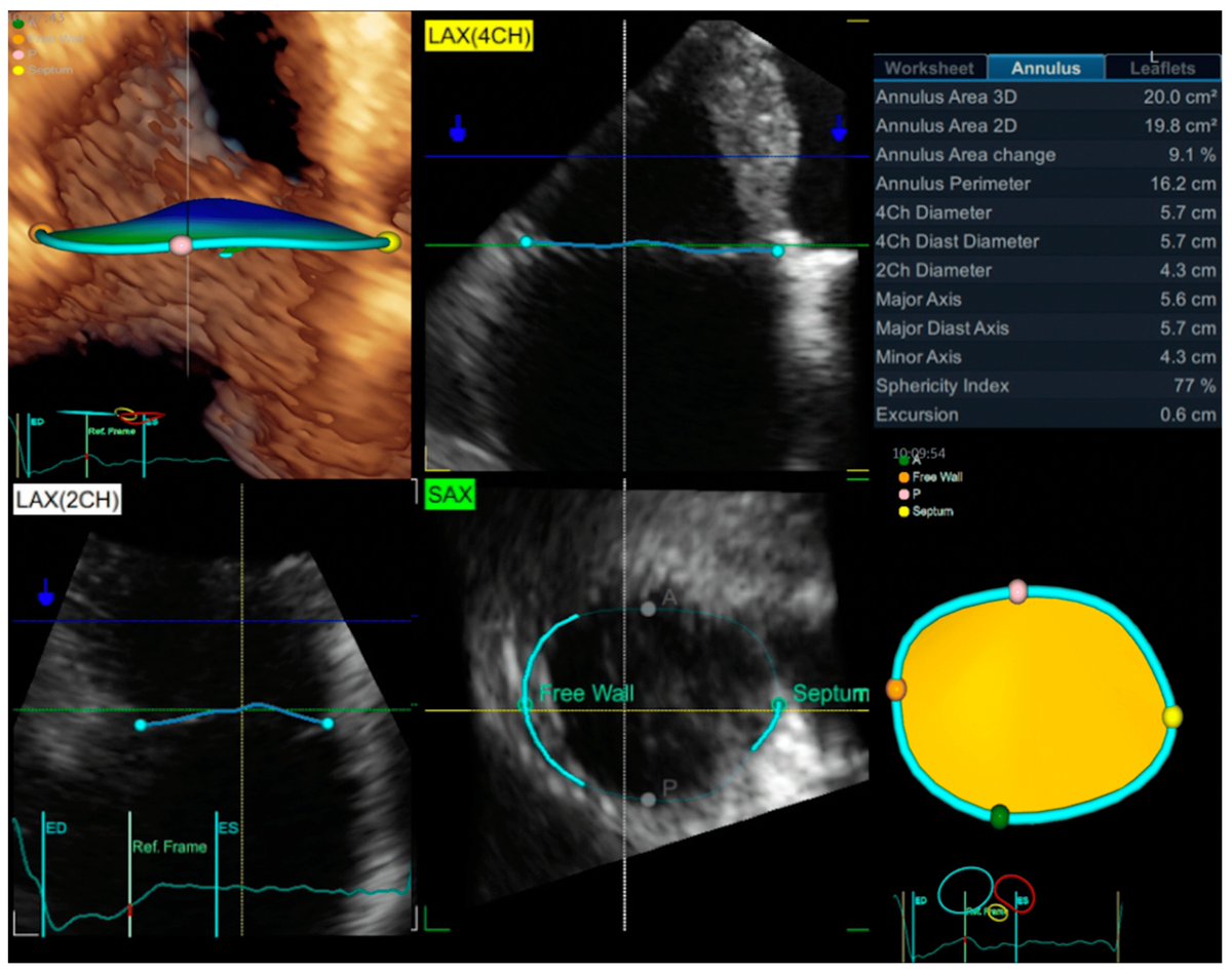 JCM MDPI (@jcm_mdpi) on Twitter photo #mdpijcm
🔍Editor’s Choice Articles
🛎️Welcome to this paper on Atrial Functional Tricuspid Regurgitation as a Distinct Pathophysiological and Clinical Entity.
<a href="/UMFCraiova/">University of Medicine and Pharmacy of Craiova</a> <a href="/dianarflorescu/">Diana Hădăreanu</a> <a href="/denisamuraru/">Denisa Muraru</a> <a href="/gavazzoni_mara/">MARA Gavazzoni</a> <a href="/CaravitaSergio/">Sergio Caravita</a> <a href="/GParati22/">Gianfranco Parati MD, FESC</a> <a href="/lpbadano/">Luigi</a>
🔗mdpi.com/1447566 #mdpijcm
🔍Editor’s Choice Articles
🛎️Welcome to this paper on Atrial Functional Tricuspid Regurgitation as a Distinct Pathophysiological and Clinical Entity.
<a href="/UMFCraiova/">University of Medicine and Pharmacy of Craiova</a> <a href="/dianarflorescu/">Diana Hădăreanu</a> <a href="/denisamuraru/">Denisa Muraru</a> <a href="/gavazzoni_mara/">MARA Gavazzoni</a> <a href="/CaravitaSergio/">Sergio Caravita</a> <a href="/GParati22/">Gianfranco Parati MD, FESC</a> <a href="/lpbadano/">Luigi</a>
🔗mdpi.com/1447566