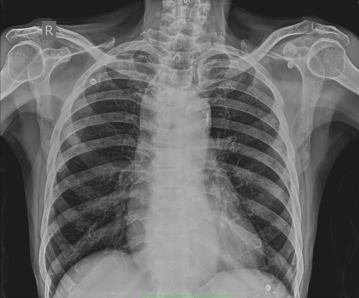 #POCUS 🎅🎄 Quiz: While doing #gastricultrasound ….you find this ?? What is it ? (CXR as clue) ! @dandamudivasu @ASRA_Society @ESRA_Society @AoraIndia @PerlasAnahi @shaskinsMD @rosie_hogg @Wilkinsonjonny @iceman_ex @Nadia_Hdz_MD @Siva6faces @RJonesSonoEM @anesthesiadocmd