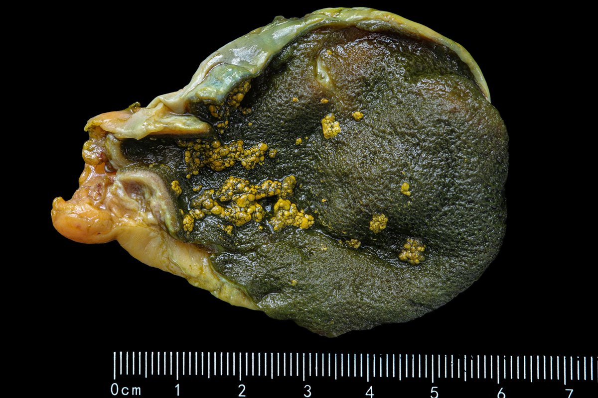 Gallbladder: Cholesterolosis vs Cholesterol polyp. Christmas game: Find the differences… 1 Level: 3 🎁 #gipath #pathology #grosspat #pathoutpic