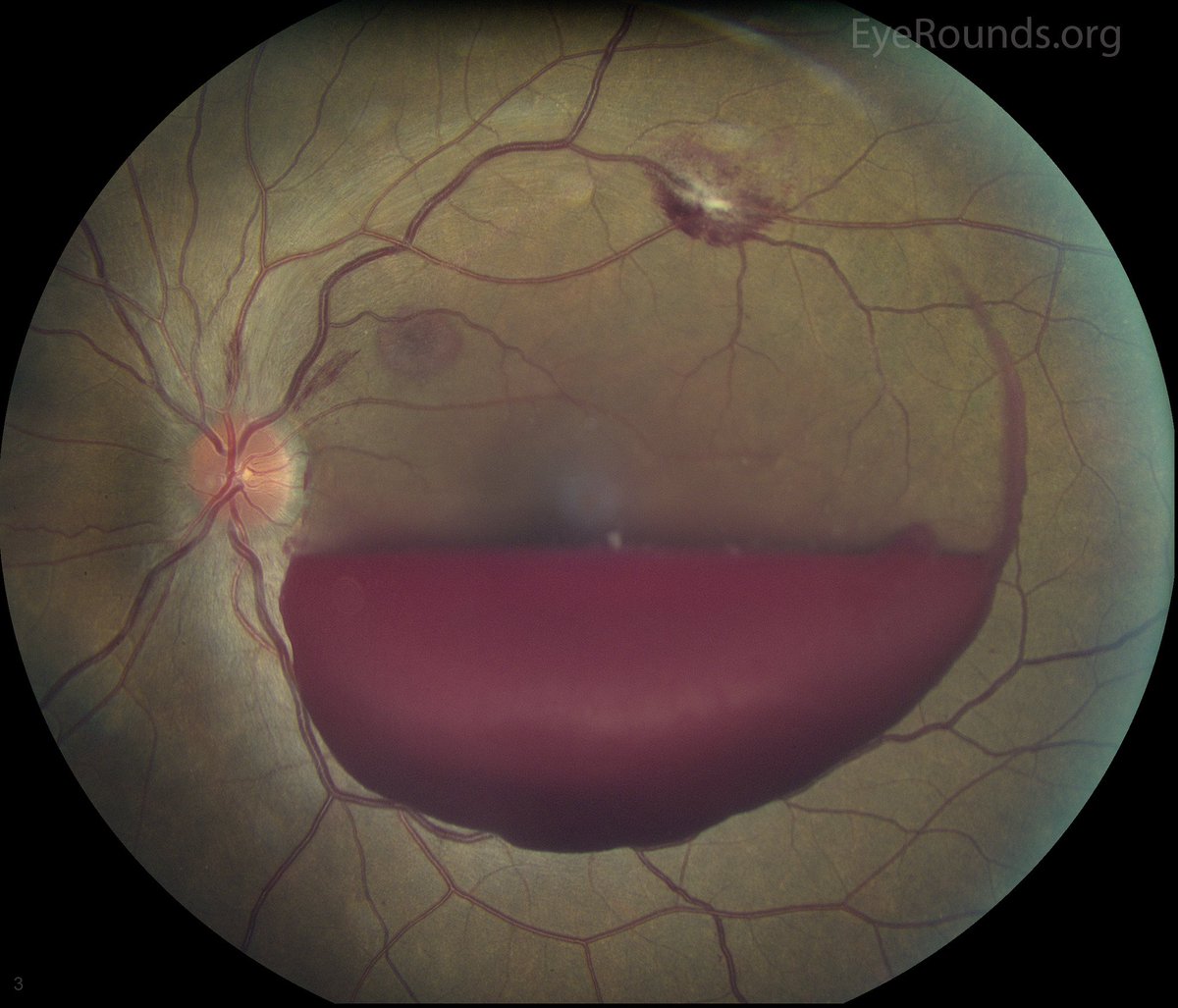 IhabFathiSulima's tweet photo. A Patient lost vision after very severe headache. No trauma.
What is the diagnosis /syndrome?
What is Epidemiology? https://t.co/6SfloxB3kg