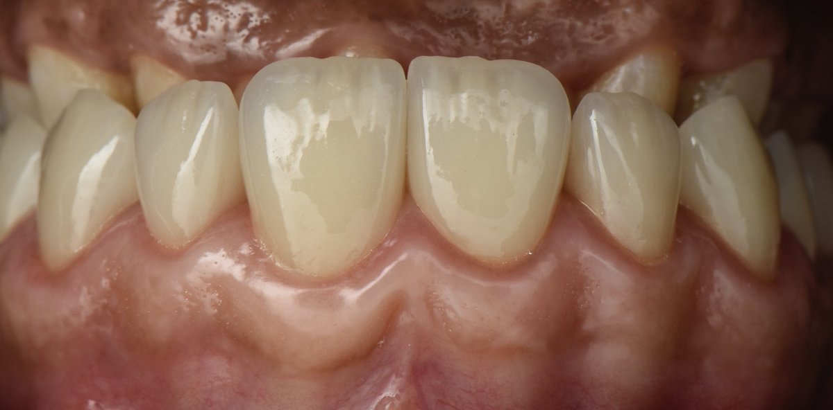 Before and after 🪄
Crown lengthening followed by 10 units e-max crowns ✨