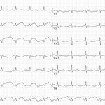 Photo by ECG Cases (@ecg_cases)