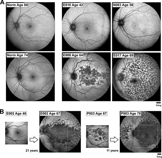 ARVOiovs's tweet photo. Artur V. Cideciyan @cideciya et al. @ScheieEye describe a treatment strategy with gene editing for late-onset retinal degeneration caused by a founder variant in C1QTNF5. 
https://t.co/cJTpB64I7b https://t.co/YuoOSNl1Ht