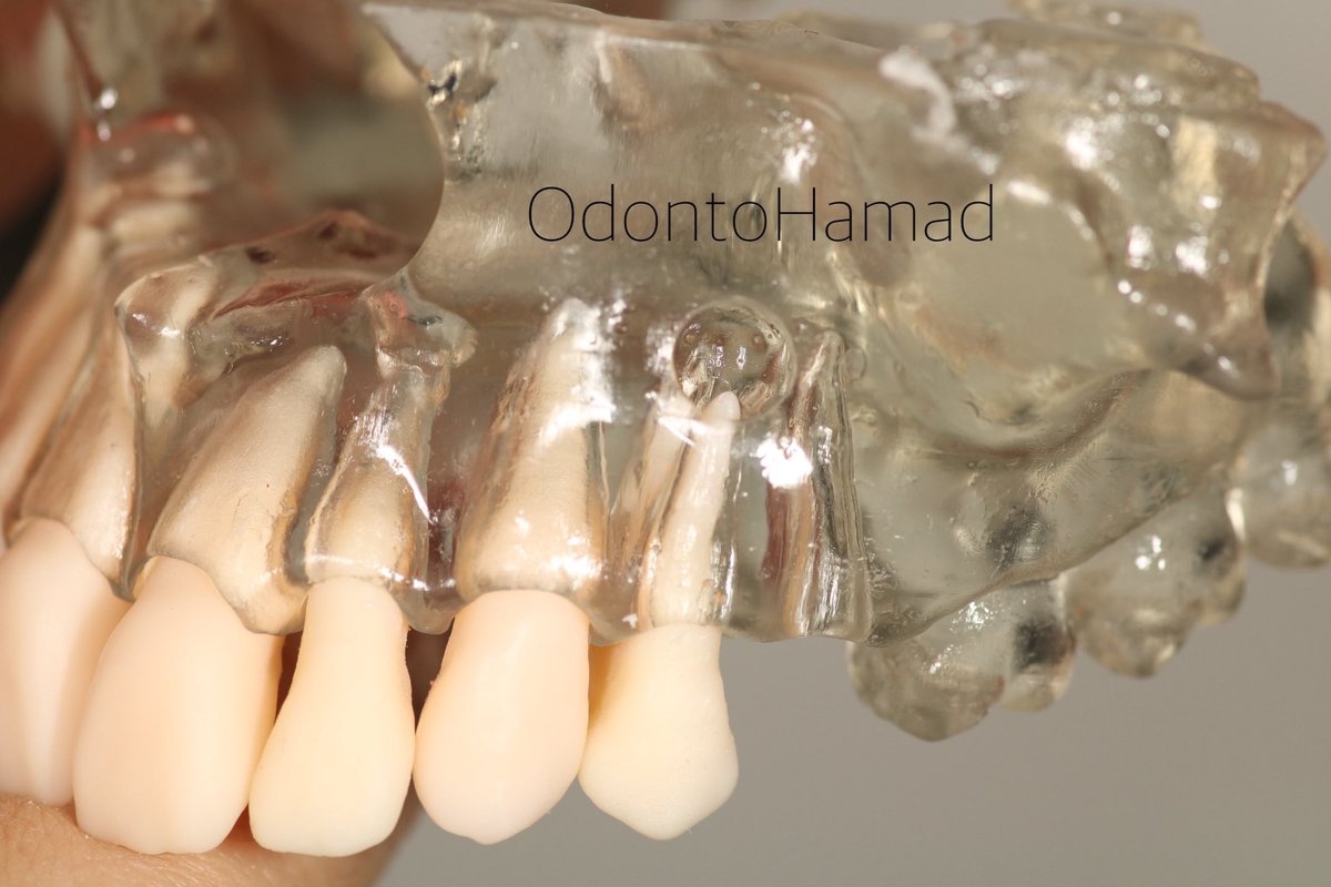 OdontoHamad's tweet photo. موديل جديد 😍 من تصميمنا ، متخصص بالتدريب على Apicoectomy فيه 5 lesions
1 perforating the Bone 
4 within the bone needs bone removal to access 

و نقدر نخصصه على كيفكم 😏

- اللثة ماركبناها على الموديل ، لانها بتغطي كل التفاصيل الي قاعدين تشوفونها 😁 https://t.co/HHwSzxtVS5