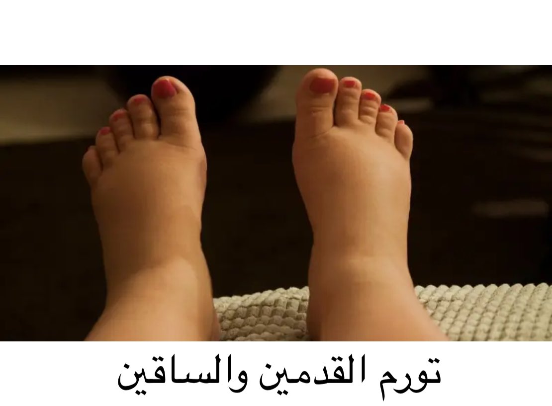 Dr_mahaalnemer's tweet photo. معلومة

✅ تورم القدمين في الحمل : طبيعي بسبب ضغط الرحم على اوردة الحوض
وقد يكون التورم في جهه أكثر من الاخرى طبيعي 

♦️وعندما يكون تورم الساق والقدم في جهه واحده مصاحباً:
▪️ لألم في الساق 
▪️إحمرار الجلد
▪️حرارة الساق مع تغيير في حجم الساقين 

✅هذا يعطي إحتمال جلطة وريديه بالساق وتحتاج التوجه للطوارئ فوراً للعلاج