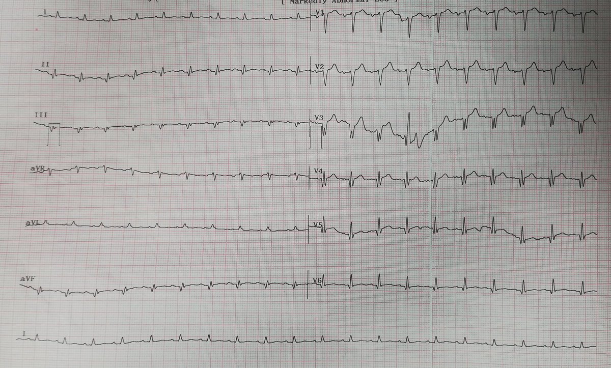 Madiha Fatima (@fatimamadiha) on Twitter photo 75 year old male, known ICMP, presneted with APE and with ECG below, DCC done, Comments??
<a href="/HaseebR78219592/">Haseeb Raza</a> <a href="/ecgandrhythmRoe/">Dr. Andreas Roeschl</a> <a href="/TheEKGGuy/">Anthony Kashou, MD</a>
#EKGs #ECG 75 year old male, known ICMP, presneted with APE and with ECG below, DCC done, Comments??
<a href="/HaseebR78219592/">Haseeb Raza</a> <a href="/ecgandrhythmRoe/">Dr. Andreas Roeschl</a> <a href="/TheEKGGuy/">Anthony Kashou, MD</a>
#EKGs #ECG