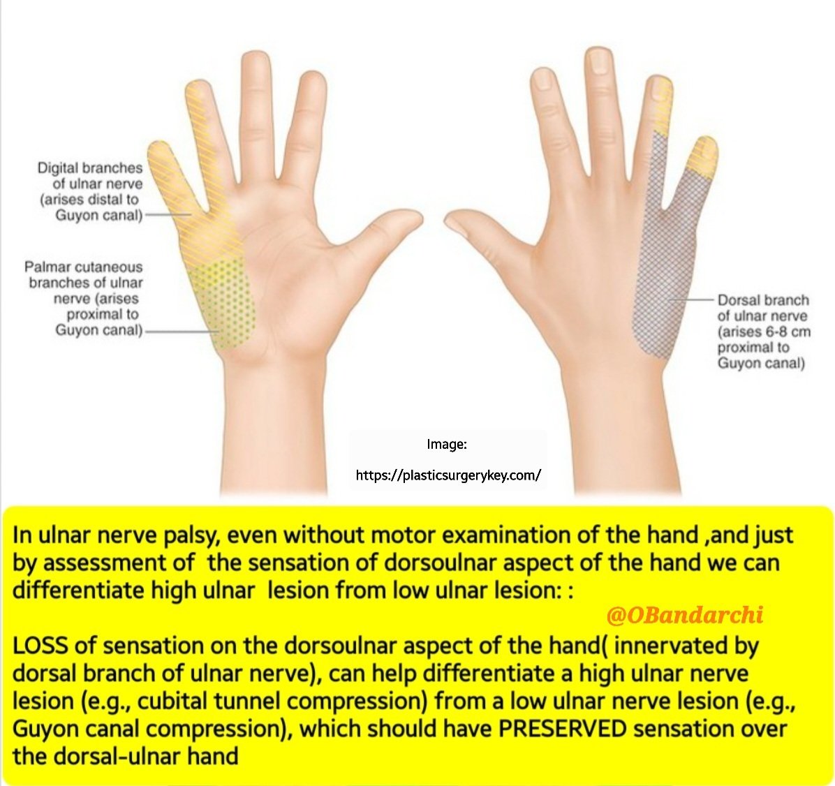 Even without motor examination of hand, assessing sensation of dorsoulnar aspect of hand alone,helps a lot to differentiate high ulnar lesion (e.g cubital tunnel compression) from low ulnar lesion(e.g. Guyon canal):
👉The key is LOSS vs PRESERVED sensation of dorsoulnar of hand⬇️