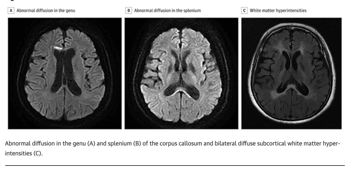 Do you look at the corpus callosum when sorting out a neurological diagnosis. Many folks don't and the answer may be right in front of your eyes as Xie and Sun teach us @JAMANeuro Key points: - In this case progressive memory loss and left limb numbness. - Misdiagnosed as a…