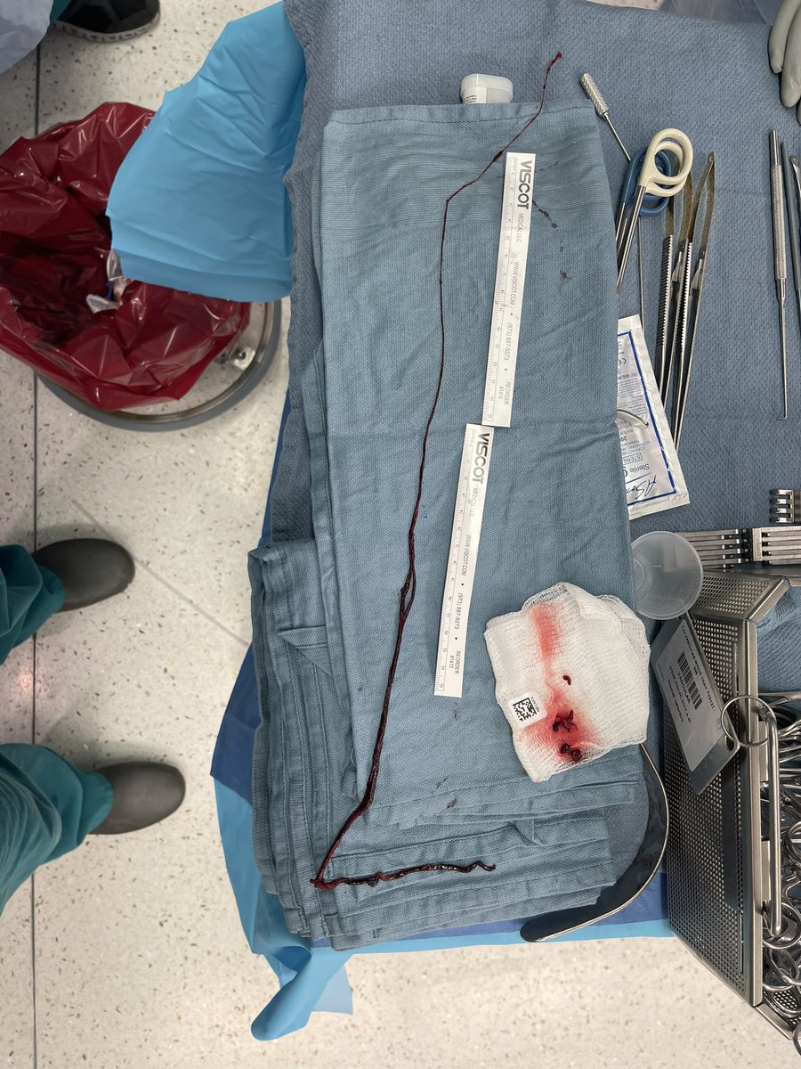 Closing out 7 days of call! #Christmas #vascular #thrombectomy #acutelimbischemia #MedEd <a href="/gaurangjoshimd/">Gaurang Joshi</a> <a href="/JEFFsurgery/">Jefferson Surgery</a> <a href="/JeffersonVSIG/">Jefferson Vascular Surgery Interest Group</a>