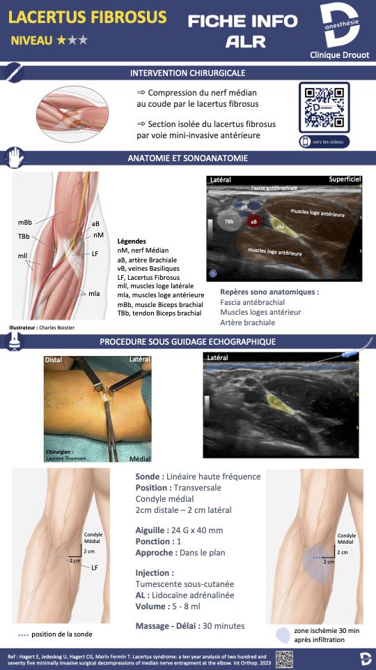 🎁 Anesthésie pour la chirurgie de libération du nerf médian au coude ou section du lacertus fibrosus  #WALANT Toutes nos fiches : 👉🏽 lnkd.in/eJn5WVY