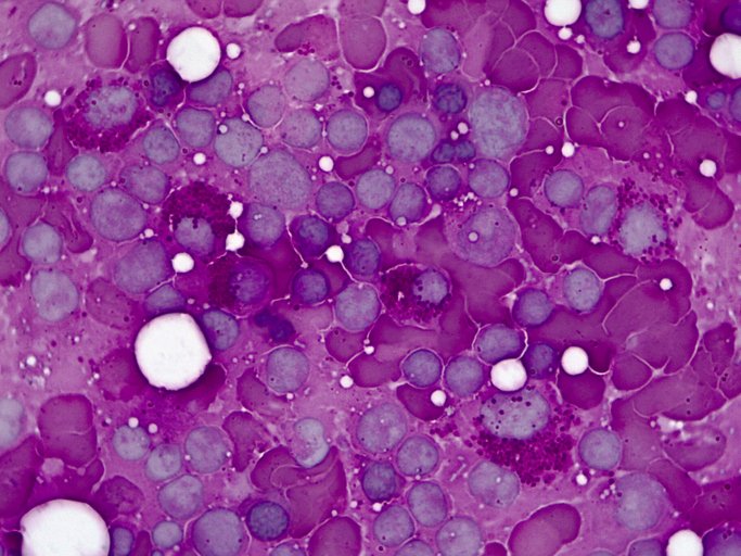 The IMJ (@the_imj) on Twitter photo IMJ December 2023 #FreeAccess
Editorial: Ethnicity in allogeneic haemopoietic stem cell transplant (HSCT)
bit.ly/3RxjDPA
<a href="/marrow/">Jeff Szer</a> <a href="/TheRACP/">The Royal Australasian College of Physicians</a> <a href="/WileyHealth/">Wiley Clinical Health</a> <a href="/mcerlean_gemma/">Gemma McErlean</a> IMJ December 2023 #FreeAccess
Editorial: Ethnicity in allogeneic haemopoietic stem cell transplant (HSCT)
bit.ly/3RxjDPA
<a href="/marrow/">Jeff Szer</a> <a href="/TheRACP/">The Royal Australasian College of Physicians</a> <a href="/WileyHealth/">Wiley Clinical Health</a> <a href="/mcerlean_gemma/">Gemma McErlean</a>