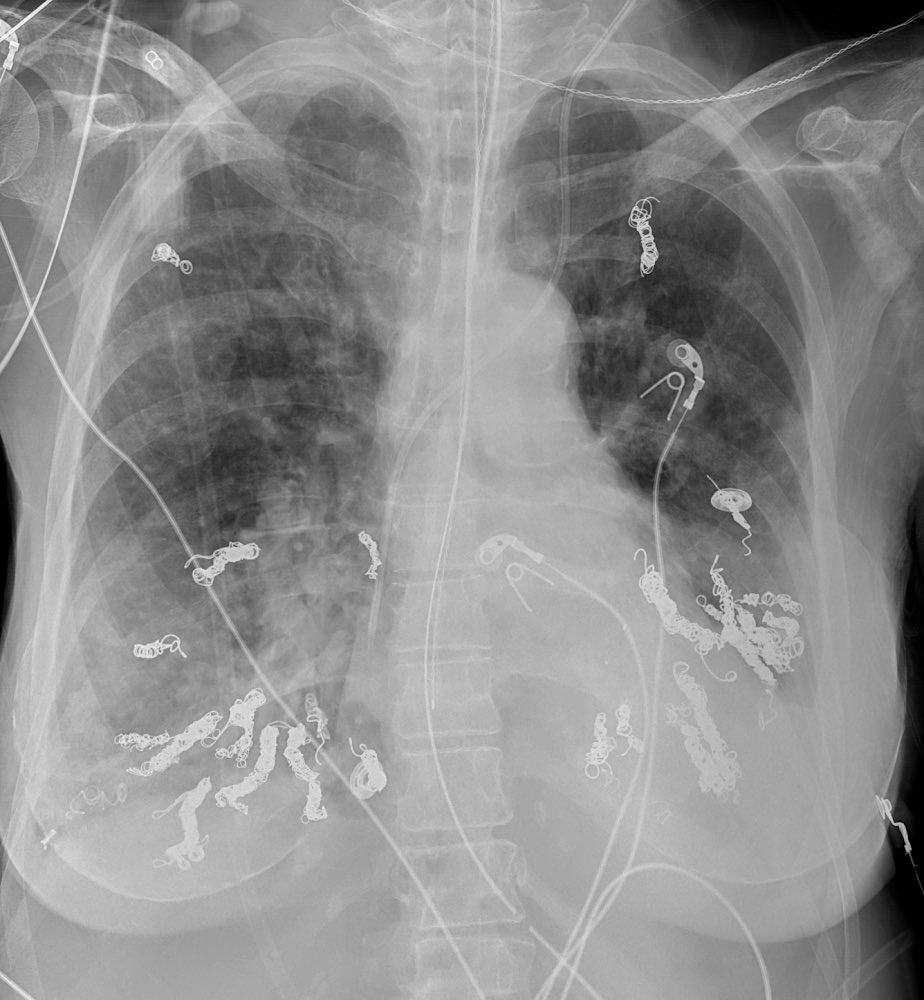 ￼Good morning! What is going on here?!?! #radres #cxr