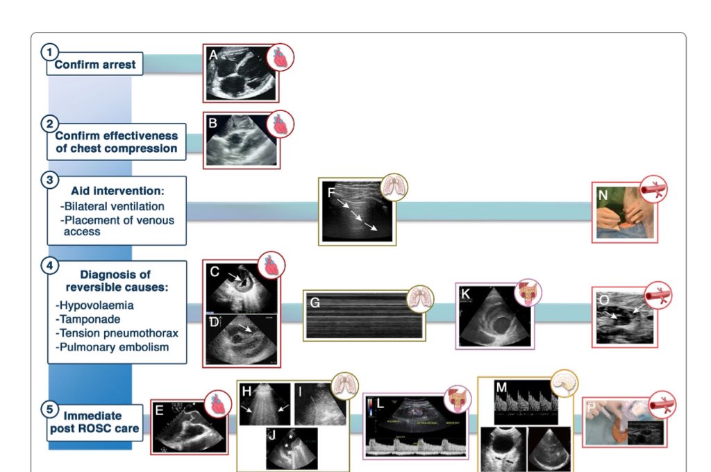 EmergPOCUS's tweet image. 🚨 Aplicación del Ultrasonido en el Paro Cardíaco 🚨

1️⃣ #Confirmación del paro: La vista subxifoidea durante un paro cardíaco permite confirmar la ausencia de actividad cardíaca sin interrumpir las compresiones torácicas. 🛑❤️🔍

2️⃣ #Efectividad de las compresiones: La…