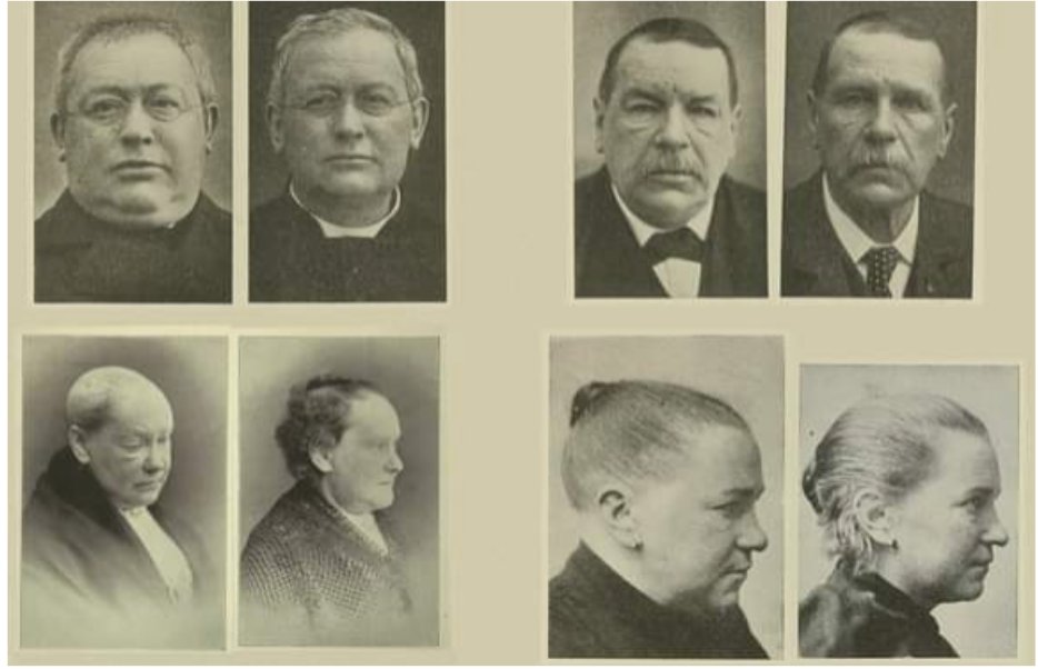 Outdoctrination's tweet image. Thanks to the late, great, Dr. Broda Barnes.

A man who helped countless people who were hopelessly sick, a mystery to standard medicine, and desperate for life.

With nothing more than a thermometer and some desiccated thyroid.

Here are some of the most shocking transformations…