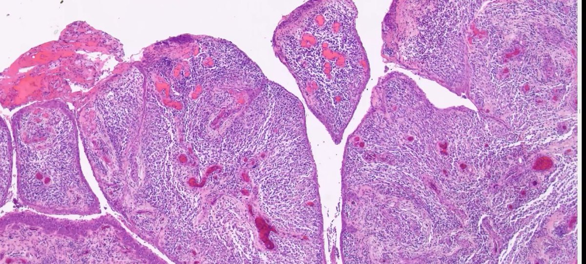 Janiranavarro's tweet image. 6yo with recent ptosis
Pic B: Squamous papilloma with marked inflammation??
Pic C: High power shows small round atypical cells.
Final diagnosis: Botryoid type embryonal rhabdomyosarcoma
Dr. Stagner and Zembowicz #ophtalmicpath #dermpath #PathX #PathTwitter #pathologists