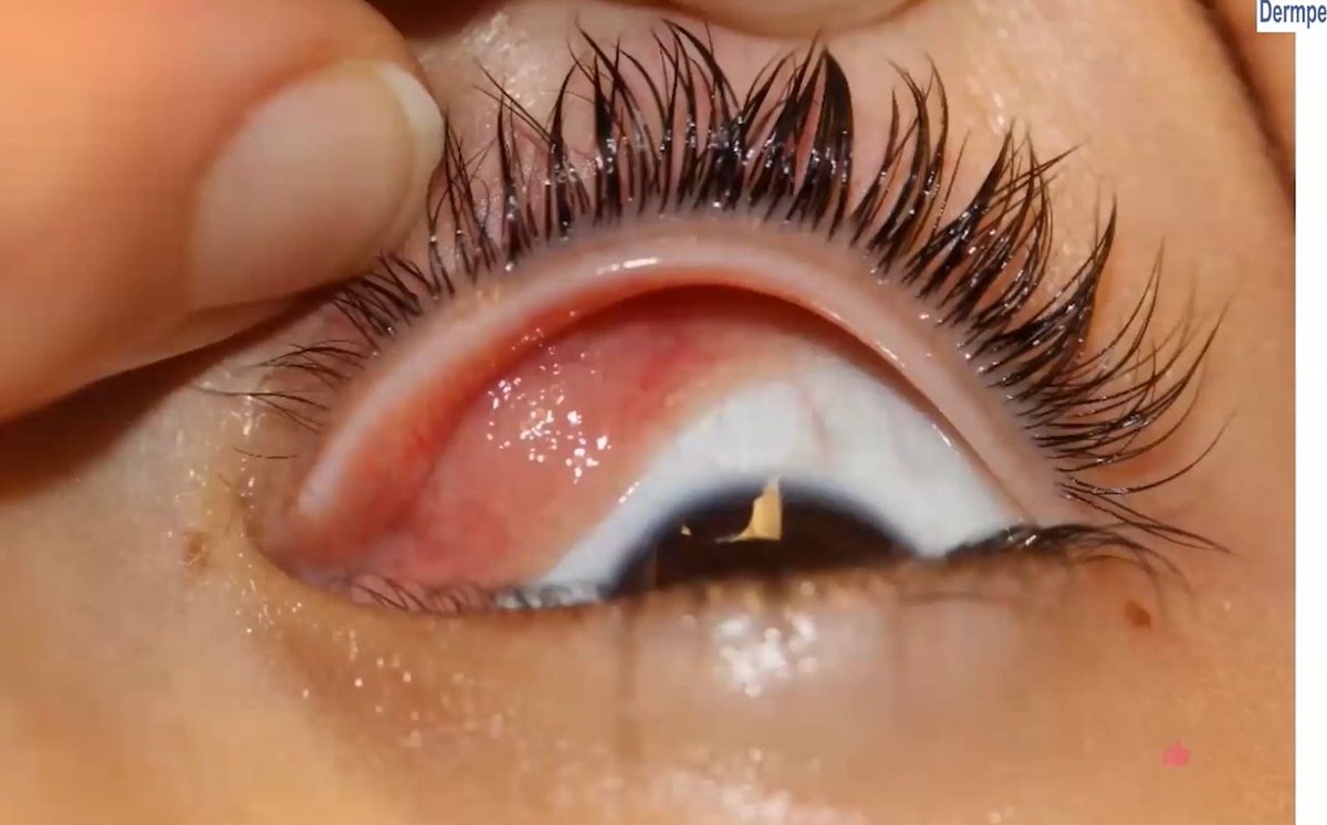 Janiranavarro's tweet image. 6yo with recent ptosis
Pic B: Squamous papilloma with marked inflammation??
Pic C: High power shows small round atypical cells.
Final diagnosis: Botryoid type embryonal rhabdomyosarcoma
Dr. Stagner and Zembowicz #ophtalmicpath #dermpath #PathX #PathTwitter #pathologists