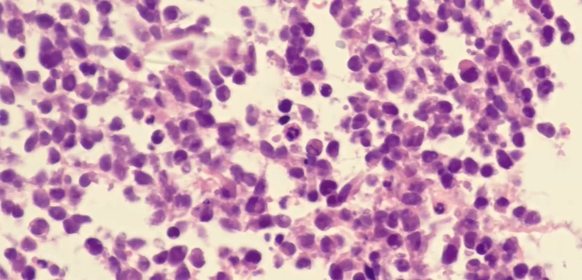 Janiranavarro's tweet image. 6yo with recent ptosis
Pic B: Squamous papilloma with marked inflammation??
Pic C: High power shows small round atypical cells.
Final diagnosis: Botryoid type embryonal rhabdomyosarcoma
Dr. Stagner and Zembowicz #ophtalmicpath #dermpath #PathX #PathTwitter #pathologists