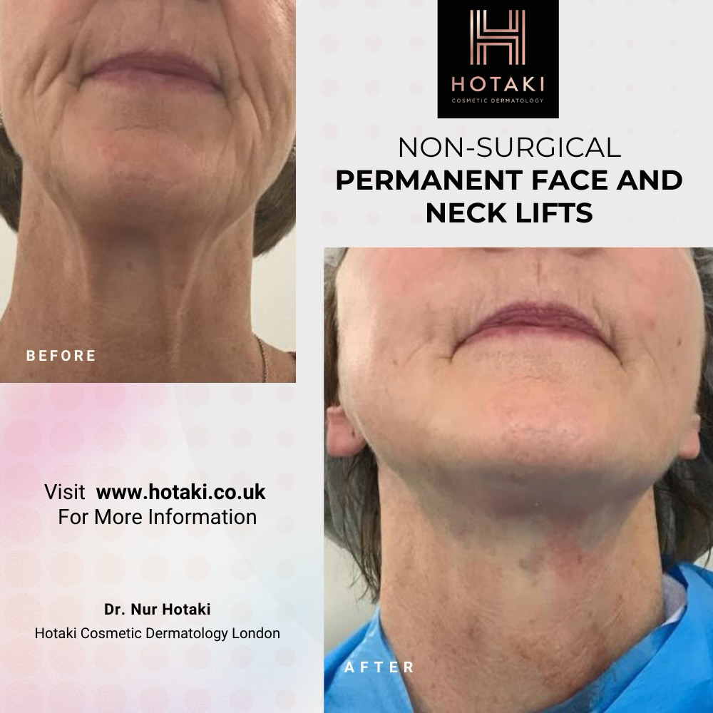 #drhotaki #hotakilondon #nonsurgicalaesthetics #aesthetictreatment #hotakicosmeticdermatology #noninvasive #nonsurgical #nonsurgicalneckLift #ageing #neckLift #lowerfacelift #nonsurgicallowerfacelift #nonsurgicalfacelift #facialrejuvenation #lowerfacelift #facelift