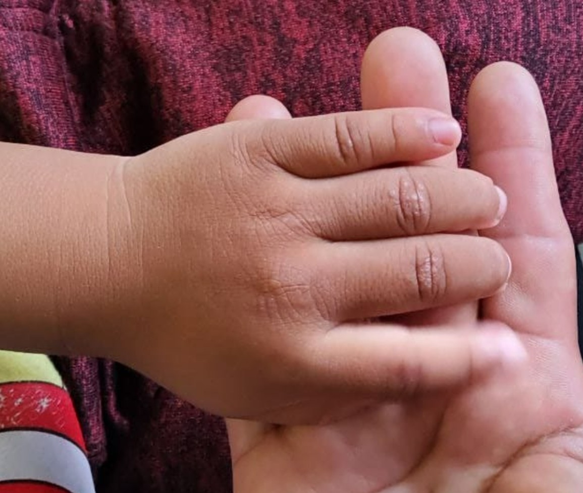 ConsejosReumato's tweet photo. La #dermatomiositis también afecta a los #niños como este preescolar de 3 años quien presentó #miopatía proximal, hiperpigmentación facial, elevación de enzimas musculares y pápulas de #Gottron como muestra la foto. #dermatomyositis #ck #Skin #muscle #children #miopathy https://t.co/C43n1mzhMz