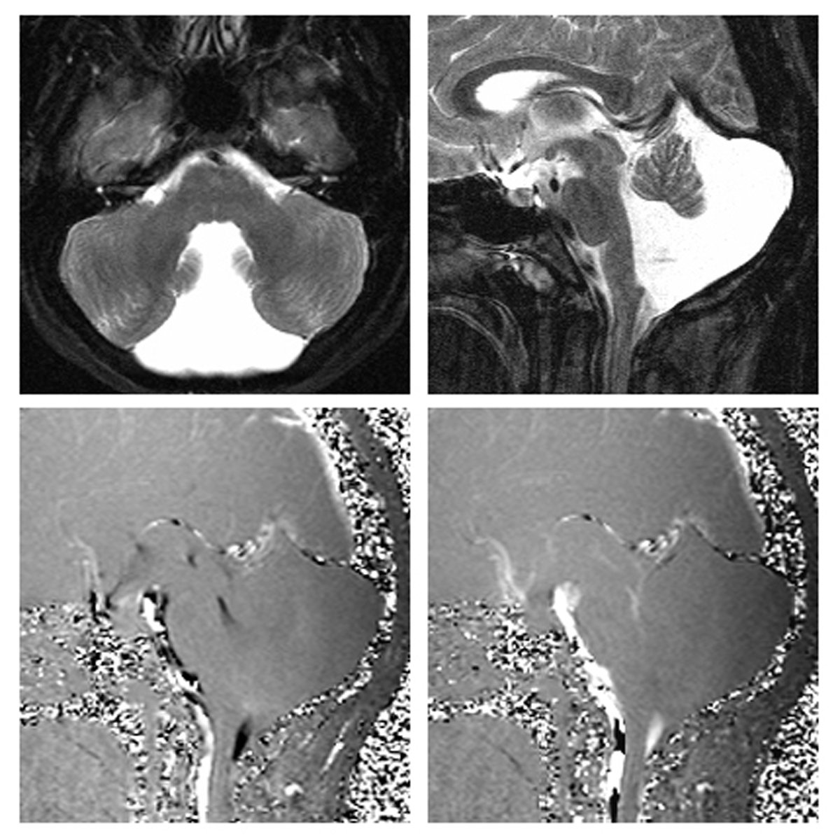drharunyildiz's tweet photo. Dandy-Walker Malformation 

Electronic Supplementary Material:
https://t.co/dq4saCUMwO
(Midsagittal closed looped phase contrast cine-MR image for Dandy-Walker Malformation)
+
#radiologicalillustration ✍️
pixel by pixel handmade! https://t.co/5L4o1TGGBB