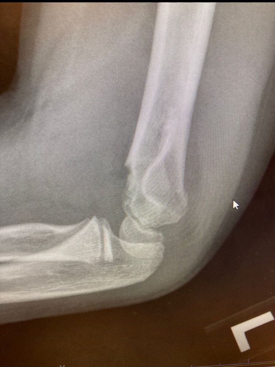 orthotraumamd's tweet photo. Child falls off monkey bars. What do you see? #orthotwitter #OrthoX #MedX #urgentCare 
@orthobullets https://t.co/syZdJWzRai