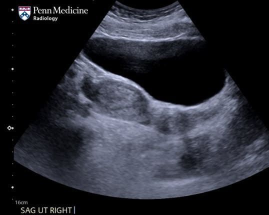 32-year-old woman with suspected pregnancy #radiology @PennMedicine bit.ly/3tz7qSQ