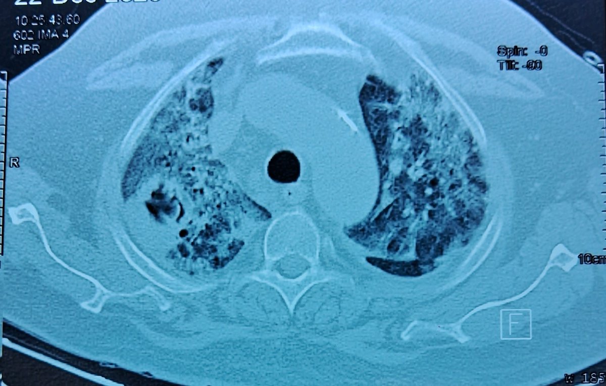 scid_ai's tweet photo. As an ID physician, when your morning round starts with this HRCT...sure shot diagnosis.
Comment below.
@savaj_pratik 

#IDCC #SCID_AI #MedTwitter #IDTwitter #InfectiousDiseases #Medfun https://t.co/h1BxnHUgJt