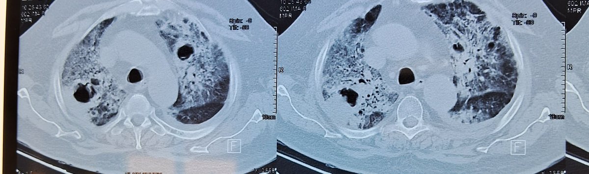 scid_ai's tweet photo. As an ID physician, when your morning round starts with this HRCT...sure shot diagnosis.
Comment below.
@savaj_pratik 

#IDCC #SCID_AI #MedTwitter #IDTwitter #InfectiousDiseases #Medfun https://t.co/h1BxnHUgJt