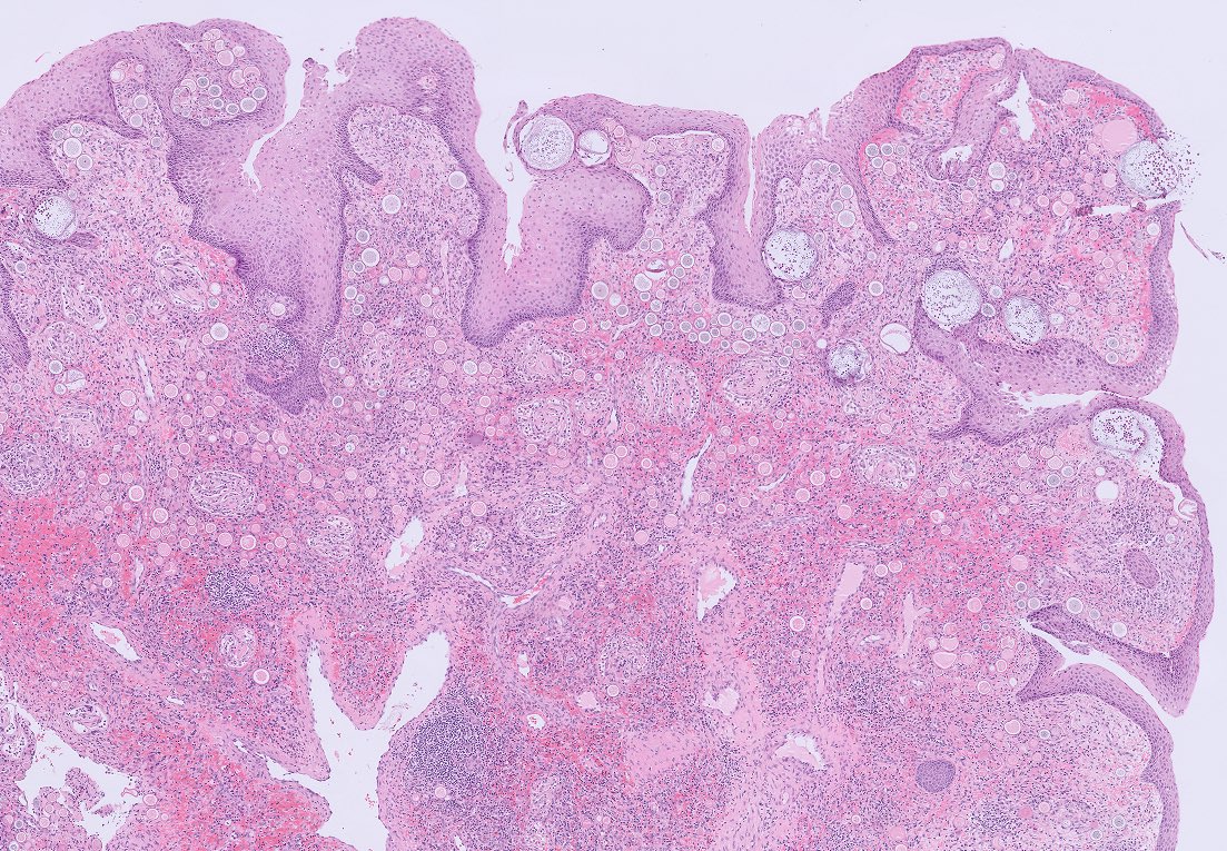 NidaMKhan0's tweet photo. Nasal polyp 
Rhinosporidiosis 🔬

#Pathology #ENTpath #PathArts #PathTwitter #PathX #Pathresidents https://t.co/EaFHESVENK