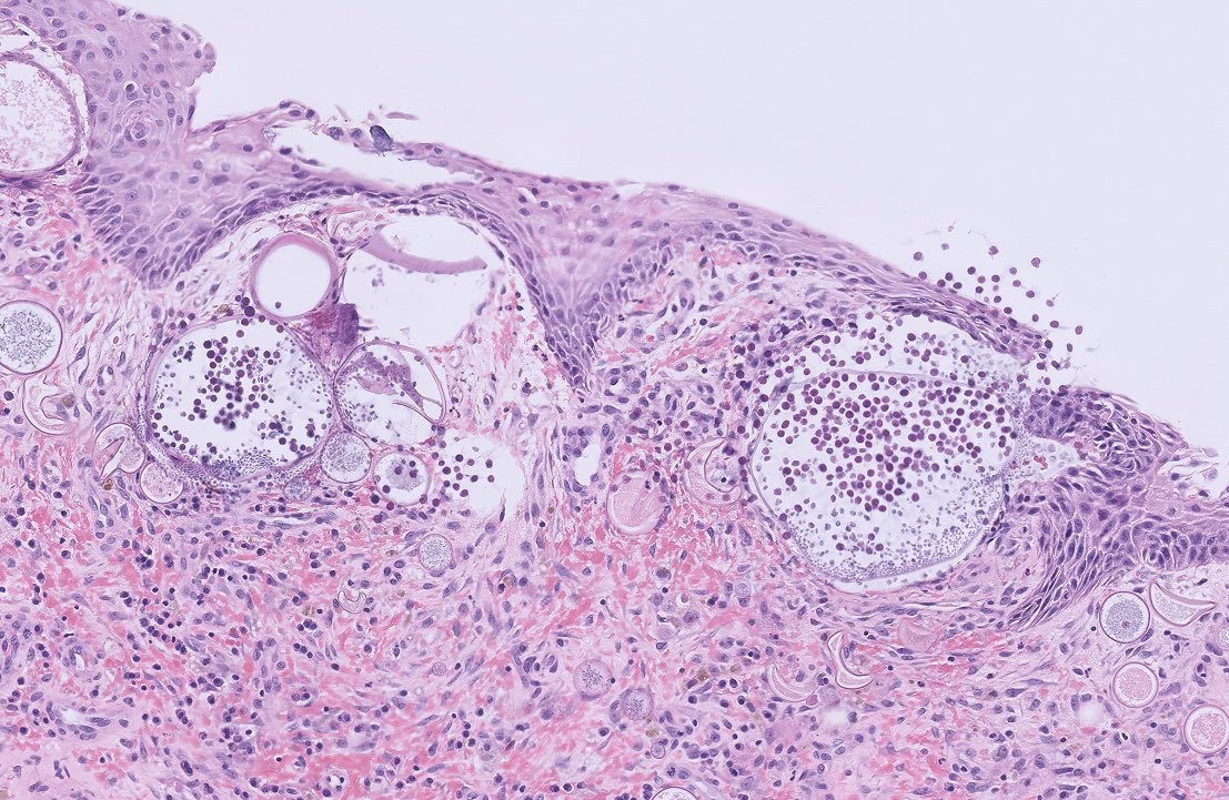 NidaMKhan0's tweet photo. Nasal polyp 
Rhinosporidiosis 🔬

#Pathology #ENTpath #PathArts #PathTwitter #PathX #Pathresidents https://t.co/EaFHESVENK