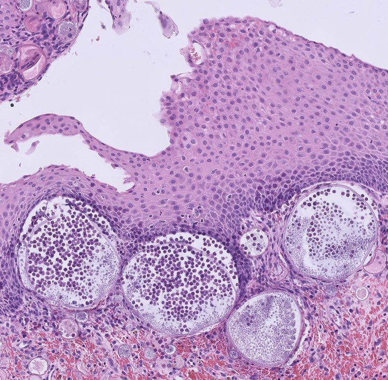 NidaMKhan0's tweet photo. Nasal polyp 
Rhinosporidiosis 🔬

#Pathology #ENTpath #PathArts #PathTwitter #PathX #Pathresidents https://t.co/EaFHESVENK