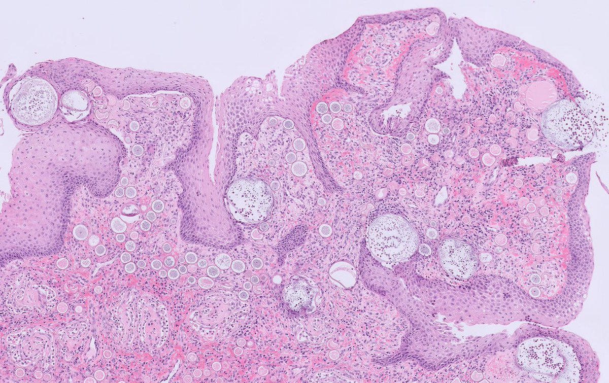 NidaMKhan0's tweet photo. Nasal polyp 
Rhinosporidiosis 🔬

#Pathology #ENTpath #PathArts #PathTwitter #PathX #Pathresidents https://t.co/EaFHESVENK