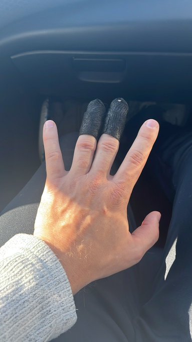 Ok so the tendons on both fingers detached from the bone so 8-12 weeks for recovery. It was surgery to