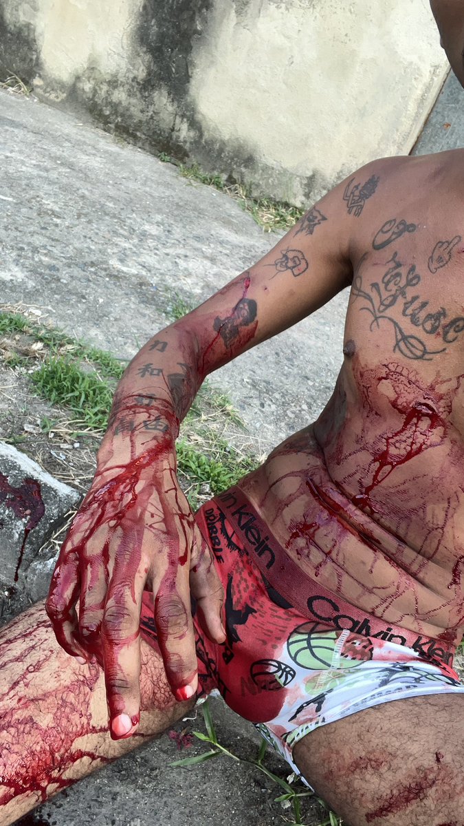 DaSul5521's tweet photo. Natal 25/23 sofri uma tentativa de homicídio de um cara que se dizia meu amigo, na manha do dia 25 enquanto eu estava dormindo ele pulou o muro da minha residência e me esfaqueou enquanto eu estava dormindo, numa atitude covarde levei 10 facadas!!! https://t.co/trZeeGLI2g