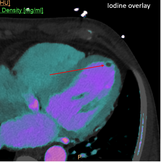 Small LV thrombus, much easier to see on iodine map and overlay with #SpectralCT.
Can be hard to see on echo. #radres, you may save a life when you call this on CT!
