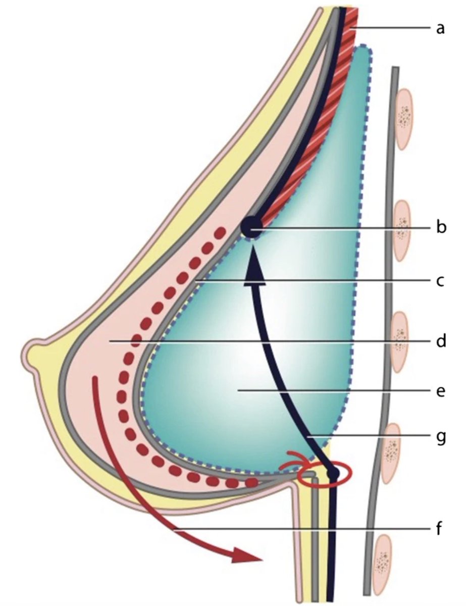 Implant-based multiplane breast augmentation—a personal surgical concept for dynamic implant–tissue interaction providing sustainable shape stability

OPEN ACCESS! From Germany 🇩🇪

link.springer.com/article/10.100…

#breastaugmentation 
#breastimplants 
#cosmeticsurgery
#plasticsurgery