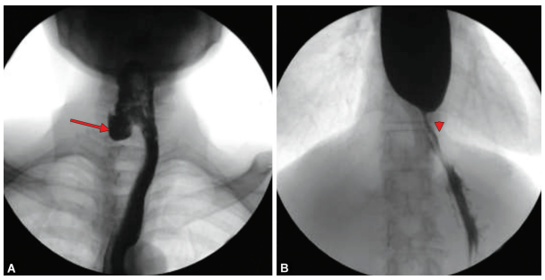 JaypeeJournals's tweet photo. Rare Association of Killian-Jamieson #Diverticulum and Peptic Stricture of the #Esophagus: Is It Causal or Casual?https://t.co/beskkPNRE5 #KuppusamySenthamizhselvan #SheikhMohammadFazleAkbar https://t.co/XnyjFxUaHE