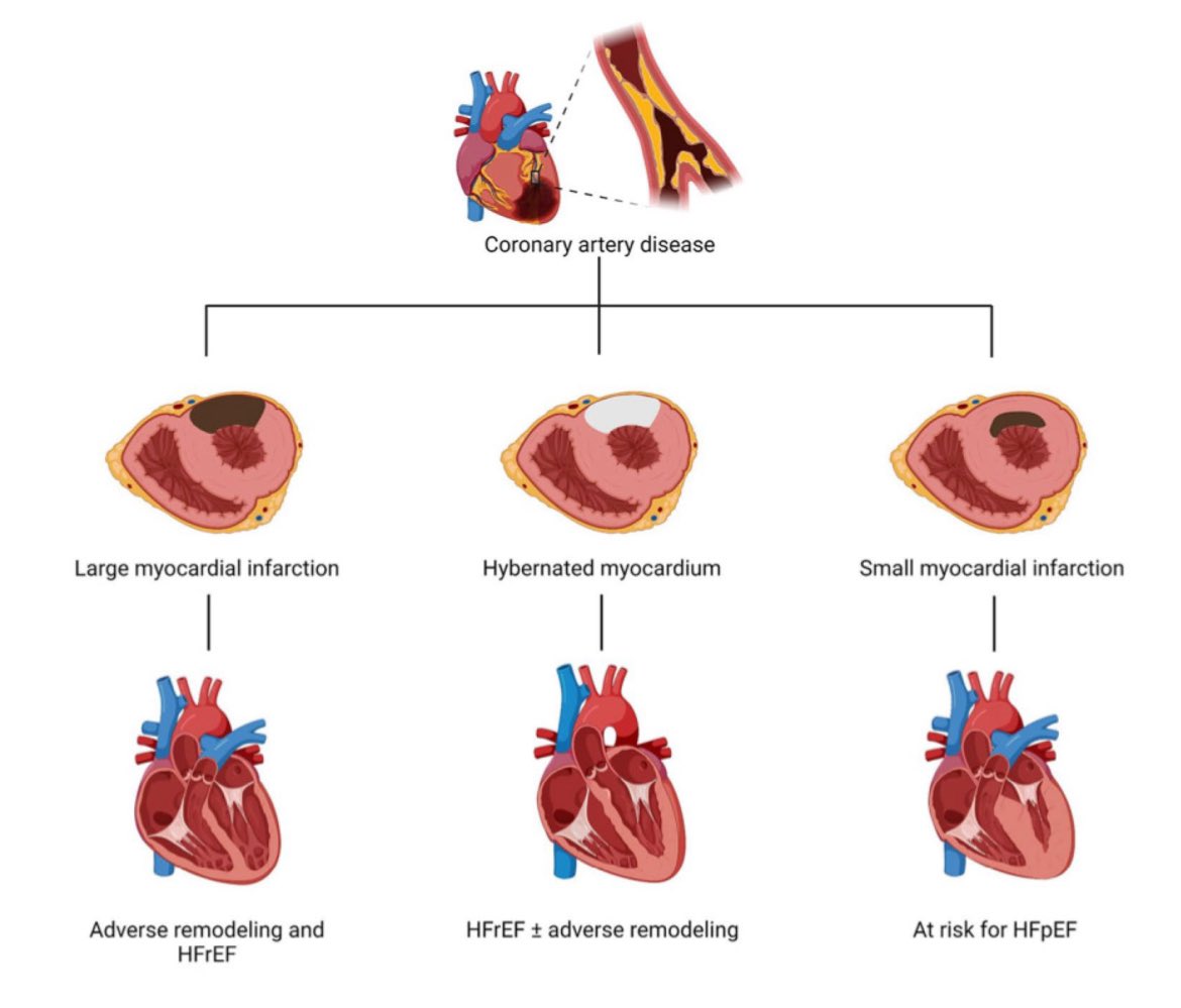 📌 𝐂𝐚𝐫𝐝𝐢𝐨𝐩𝐚𝐭í𝐚 𝐢𝐬𝐪𝐮é𝐦𝐢𝐜𝐚
Epidemiología, fisiopatología, resultados y opciones terapéuticas

☠️16% al año &amp; 40% a los 5 años

is.gd/eP2KUv