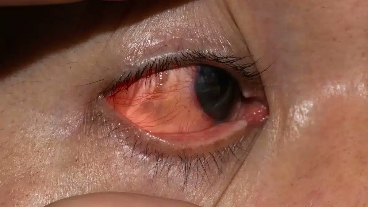 GoodRxMedicine_'s tweet photo. Navigate herpes keratitis with our comprehensive guide. Learn about symptoms, causes, and treatment options to improve your eye health 👁️
https://t.co/hP3qK4G5mD
#eyecare https://t.co/9Nrwc2vicI