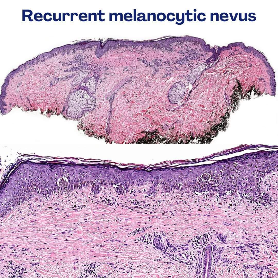 GeronimoJrLapac's tweet photo. Recurrent Nevus - A Melanoma Mimic! 😲

#pathplus #pathology #dermpath https://t.co/QrCTu9pTYl