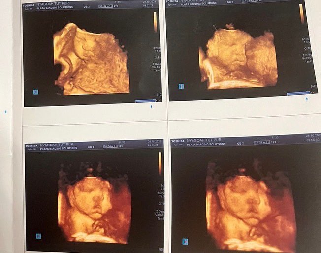 buay_tut's tweet photo. Allow me to introduce my first born  Lily Nyantham-Buay Tut. We are overjoyed and i'm so proud of my wife and baby girl for this gift of life and fatherhood 👶🏿🍼

Dad jokes loading
If a baby refuses to nap, is he guilty of resisting a rest? https://t.co/9AgSUbCHsh