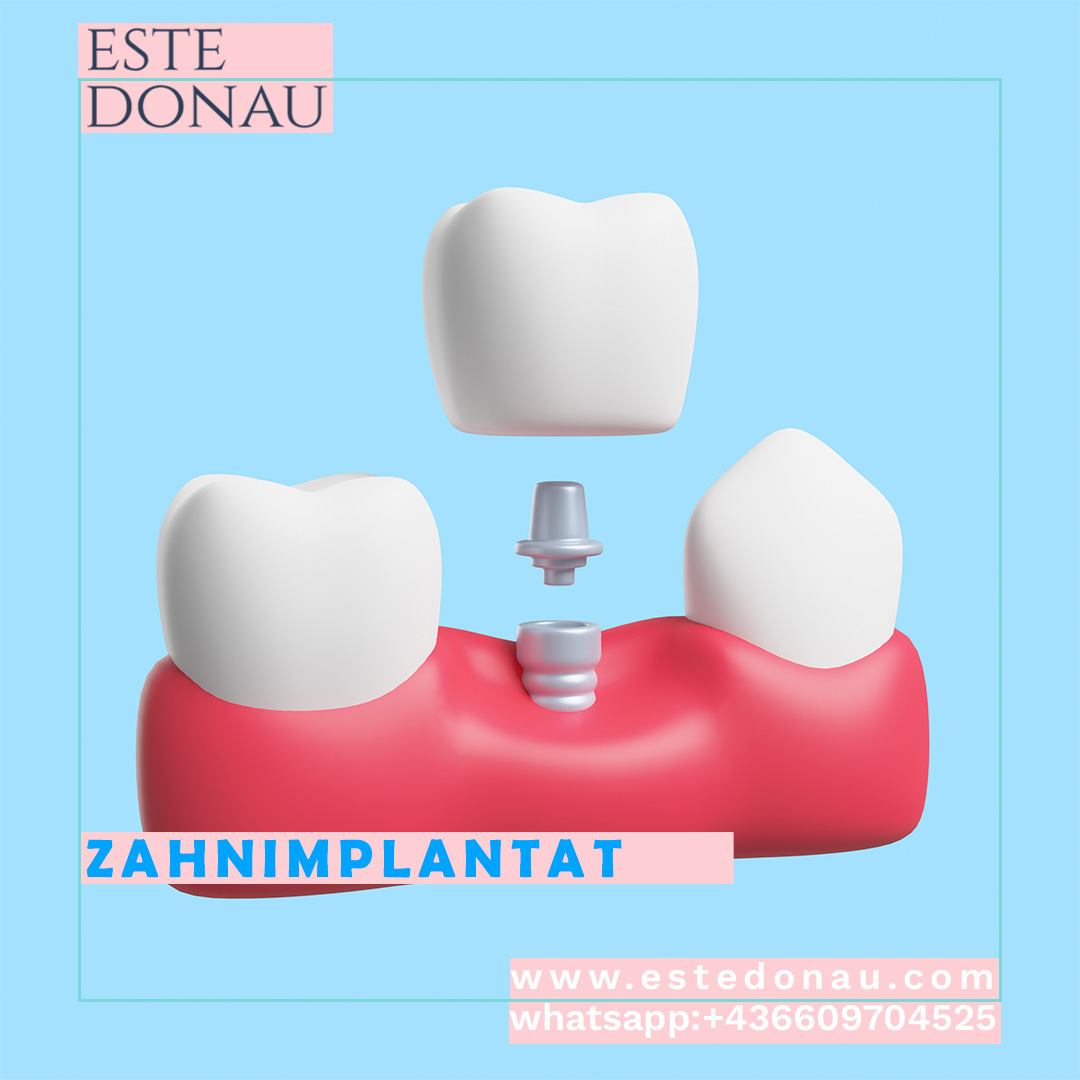 EsteDonau's tweet photo. Zahnimplantate stellen einen revolutionären Fortschritt in der Zahnmedizin dar. Es handelt sich dabei um kleine, langlebige Titanpfosten, die chirurgisch in den Kieferknochen eingesetzt werden und als künstliche Wurzeln für fehlende Zähne dienen https://t.co/QfOWoBVL0y