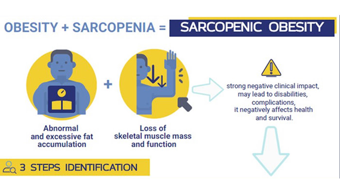 Obesity + Sarcopenia = Sarcopenic Obesity Congratulations to the teams at ESPEN and EASO who worked to develop a consensus for universally recognised diagnostic criteria for Sarcopenic #Obesity (SO). easo.org/sarcopenic-obe… @Jen_L_Baker @busetto_luca