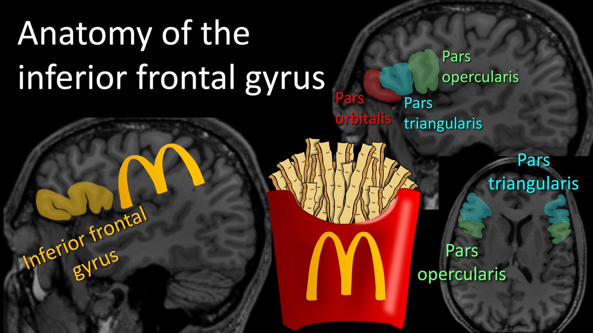 1/Do you get a Broca’s aphasia trying remember the location of Broca's area? Does trying to remember inferior frontal gyrus anatomy leave you speechless? Don't be at a loss for words when it comes to Broca's area Here’s a 🧵to help you remember the anatomy of this key region!