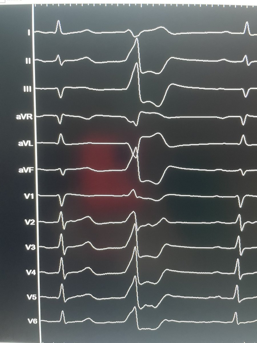 Christian-H. Heeger (@christianheeger) on Twitter photo Today I got a late Xmas present!🎄🎁🎅
Symptomatic MM PVC (18%).
What’s the location?
Please answer the POL below.
<a href="/RolandTilz/">Roland Tilz</a> <a href="/giuliavogler/">Julia Vogler</a> <a href="/CharlotteEitel/">Charlotte Eitel</a>
<a href="/Phiso_de/">Philipp Sommer</a> <a href="/chris_sohns/">Christian Sohns</a> <a href="/VanessaSciacca_/">Vanessa Sciacca</a> <a href="/DrV_Mann/">Christian Veltmann</a> <a href="/AlexandreAlmoRa/">Alexandre</a> <a href="/danielsteven_ep/">Daniel Steven</a> <a href="/AGEP_DGK/">AGEP</a> <a href="/Mel_Gunawardene/">Melanie Gunawardene</a> Today I got a late Xmas present!🎄🎁🎅
Symptomatic MM PVC (18%).
What’s the location?
Please answer the POL below.
<a href="/RolandTilz/">Roland Tilz</a> <a href="/giuliavogler/">Julia Vogler</a> <a href="/CharlotteEitel/">Charlotte Eitel</a>
<a href="/Phiso_de/">Philipp Sommer</a> <a href="/chris_sohns/">Christian Sohns</a> <a href="/VanessaSciacca_/">Vanessa Sciacca</a> <a href="/DrV_Mann/">Christian Veltmann</a> <a href="/AlexandreAlmoRa/">Alexandre</a> <a href="/danielsteven_ep/">Daniel Steven</a> <a href="/AGEP_DGK/">AGEP</a> <a href="/Mel_Gunawardene/">Melanie Gunawardene</a>